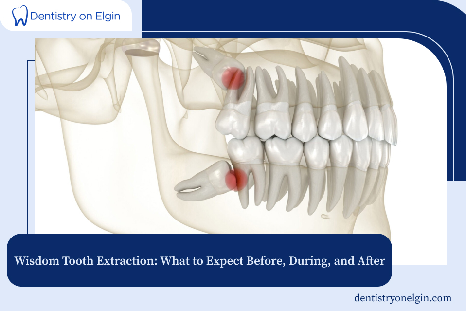 Wisdom Tooth Extraction: What to Expect Before, During, and After
